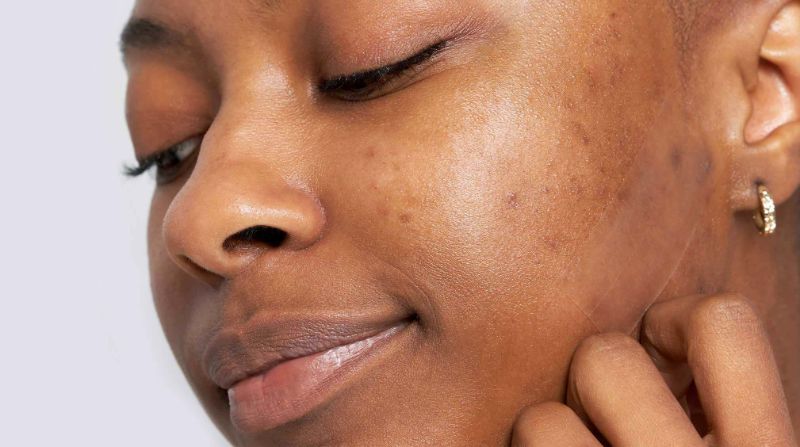 barely visible types of acne scars on woman with dark skin