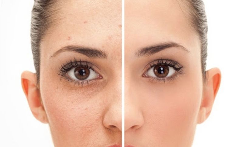 How to get rid of acne scars – tips for clear skin