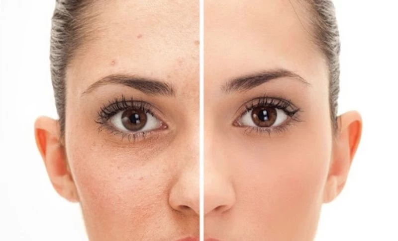 before after photo how to get rid of hyperpigmentation