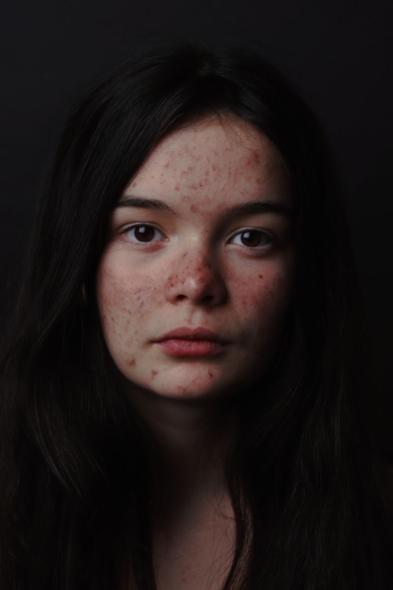 girl with acne scars best acne scar treatment long hair