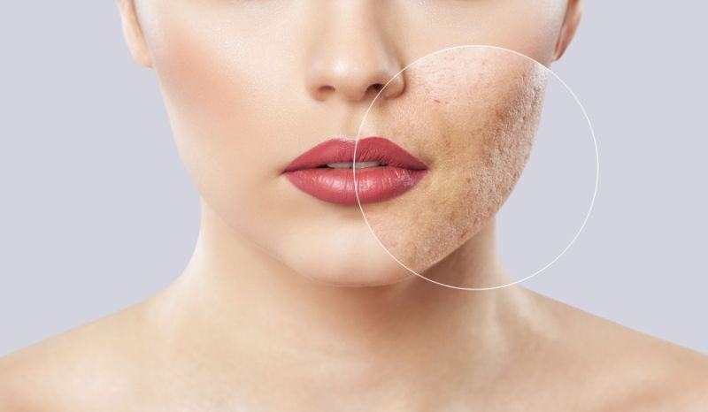how to get rid of acne scars before after photo