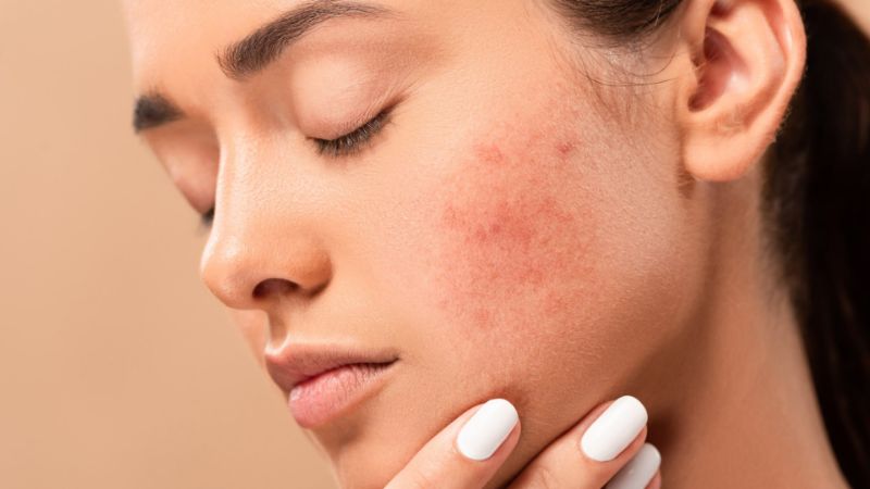 types of acne scars on cheeks brunette woman