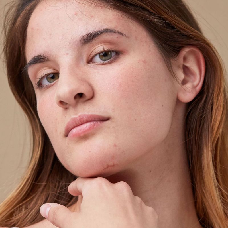 woman with acne scars how to get rid of acne scars