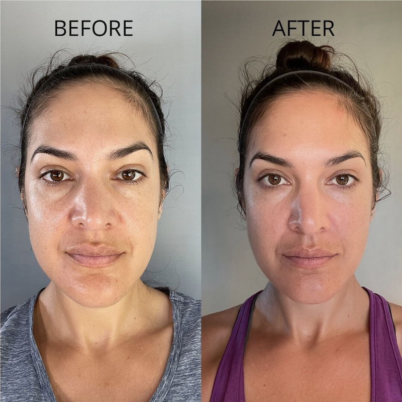 gua sha before and after amzing results for a couple of weeks