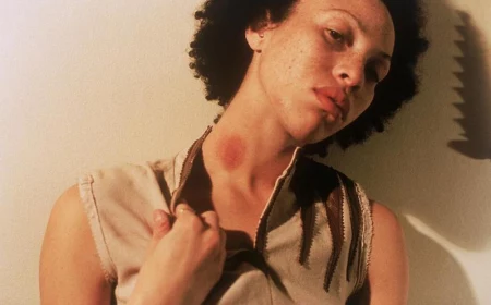how do you get rid of a hickey bruise woman with a hickey