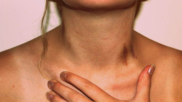 How to get rid of a hickey quick and easy archziner