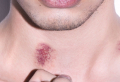 How To Get Rid Of A Hickey Quick and Easy
