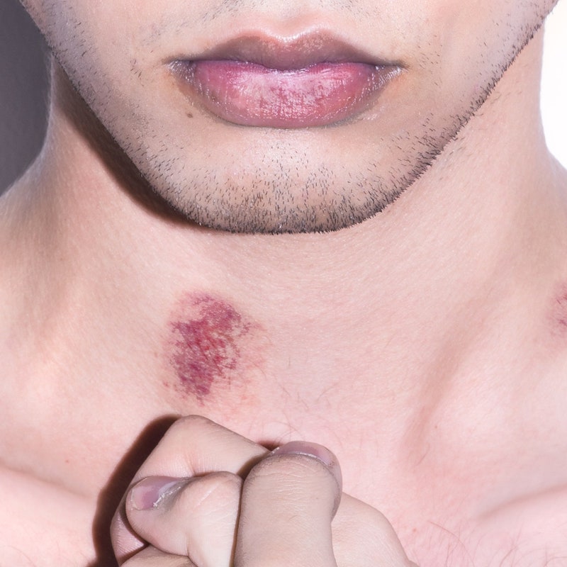 how to get rid of a hickey overnight hickey on a neck