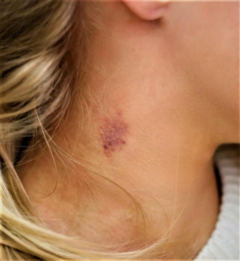 How To Get Rid Of A Hickey Quick And Easy 