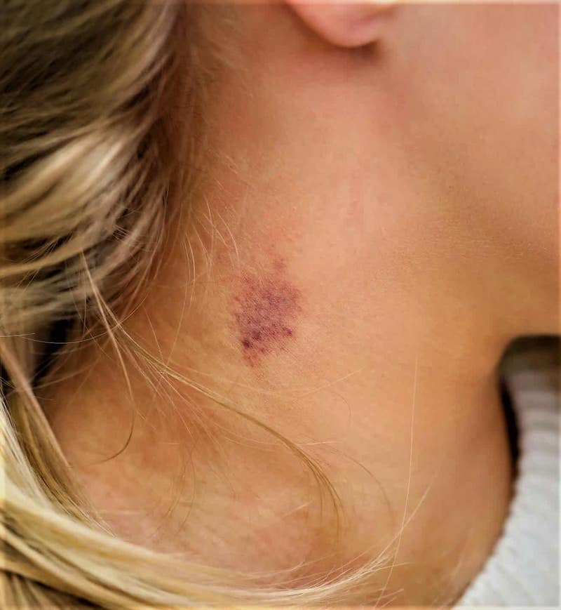 how to get rid of hickies hickey on a girls neck