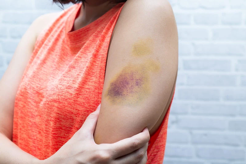 bruise,on,woman,arm.,injection,bruises.