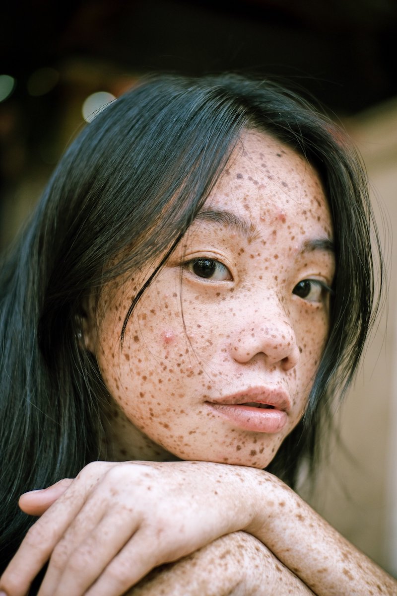 what is milk thistle used for freckled girl
