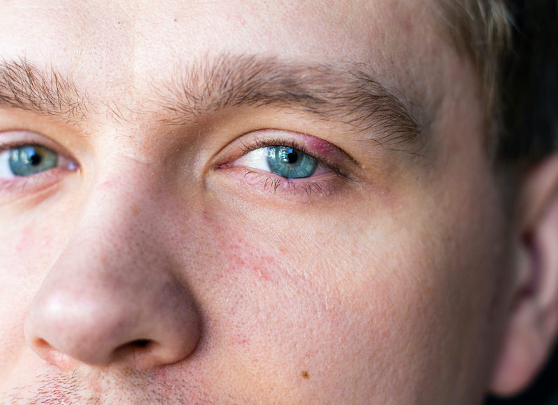person with stye on eyelid