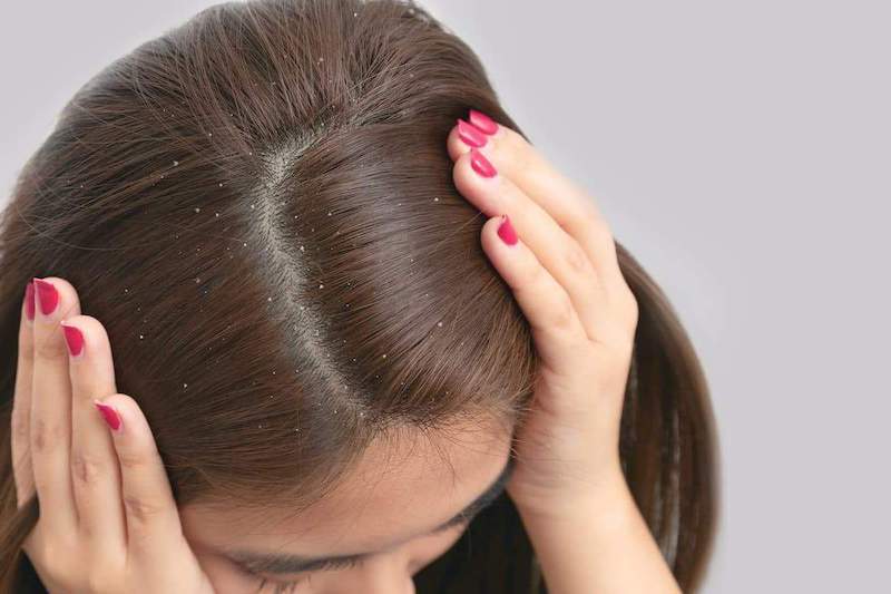 how to get rid of dandruff fast woman with pink nails parting ger hair with dandruff