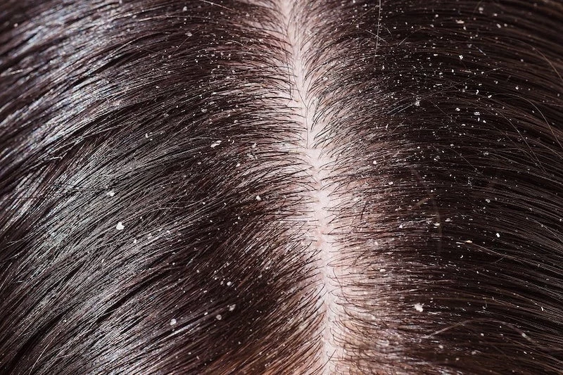 how to stop dandruff hair close up with dandruff