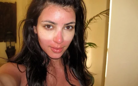 get rid of sunburn kim kardashian sunburn of glasses