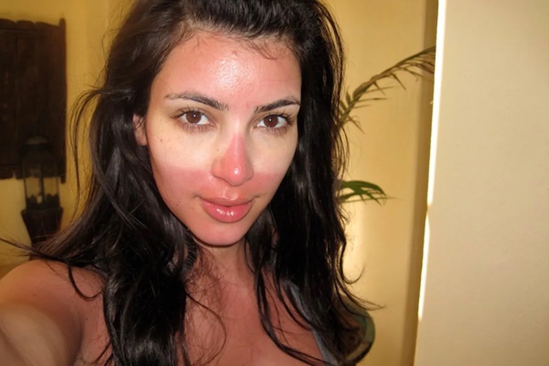 How To Get Rid of a Sunburn FAST 7+ Tips and Tricks