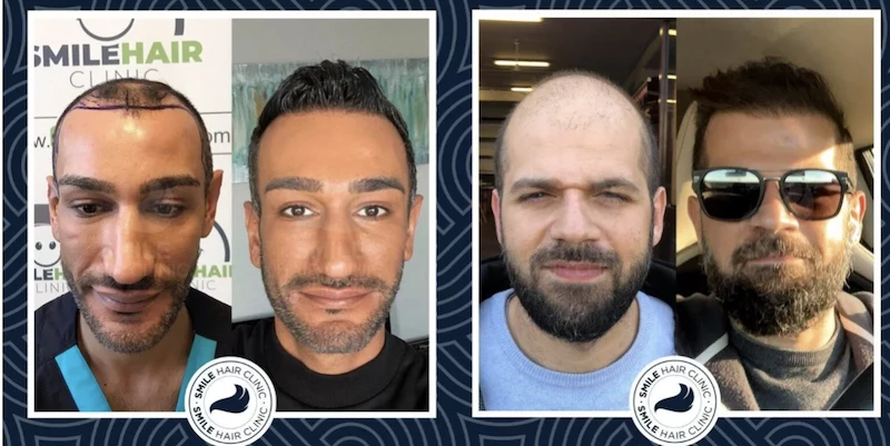 men before and after hair transplant