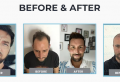 Eliminate Hair Loss Problems with a Hair Transplant in Istanbul
