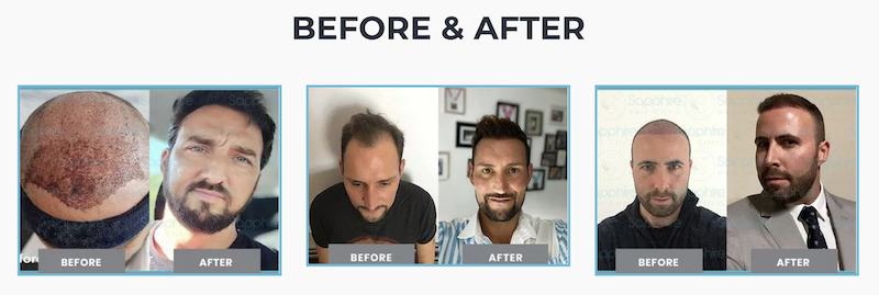 turkey hair transplant before and after
