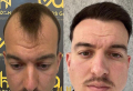 Where to Get Your Hair Transplant in Turkey?
