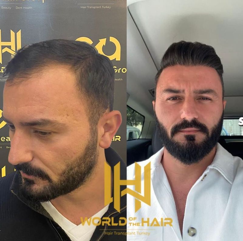 Where to Get Your Hair Transplant in Turkey?