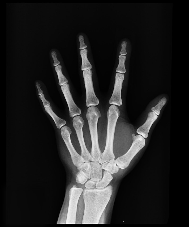 you're not getting enough protein x ray of a hand