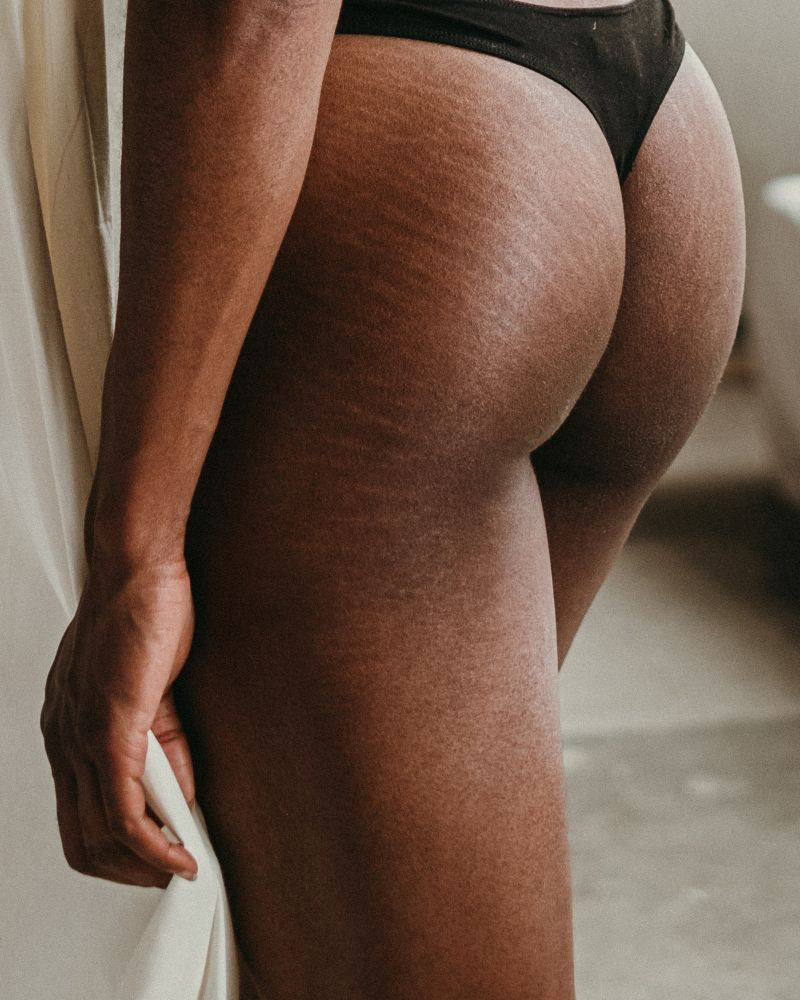 resize best remedies for stretch marks