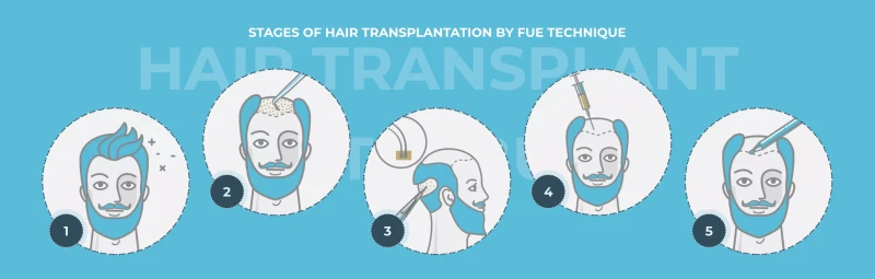 hair transplant turkey
