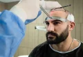 Hair Transplant Prices in Istanbul – Save With Cheap Packages