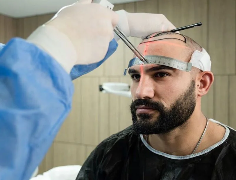 hermest hair transplant