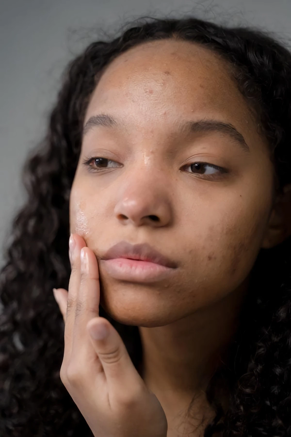 5 Foods That Cause Acne And Breakouts – Everything You Need To Know