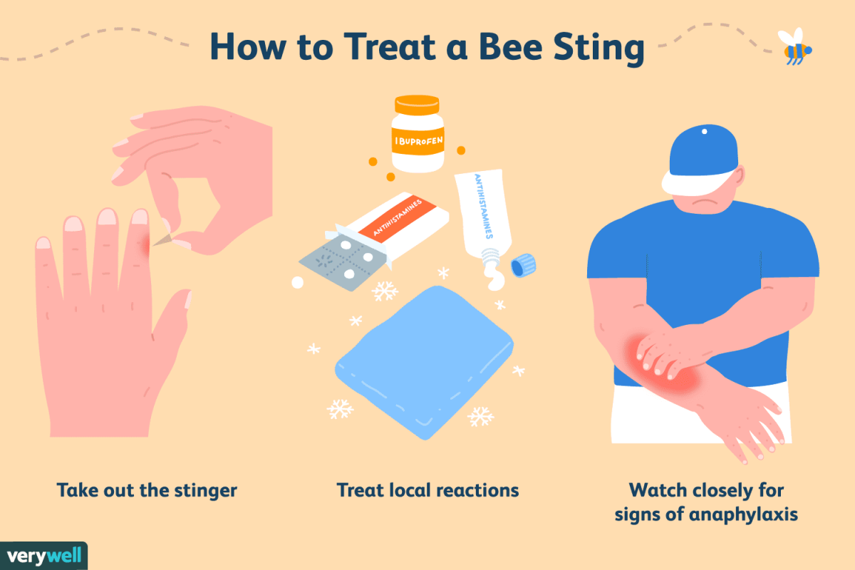 how treat bee and wasp stings