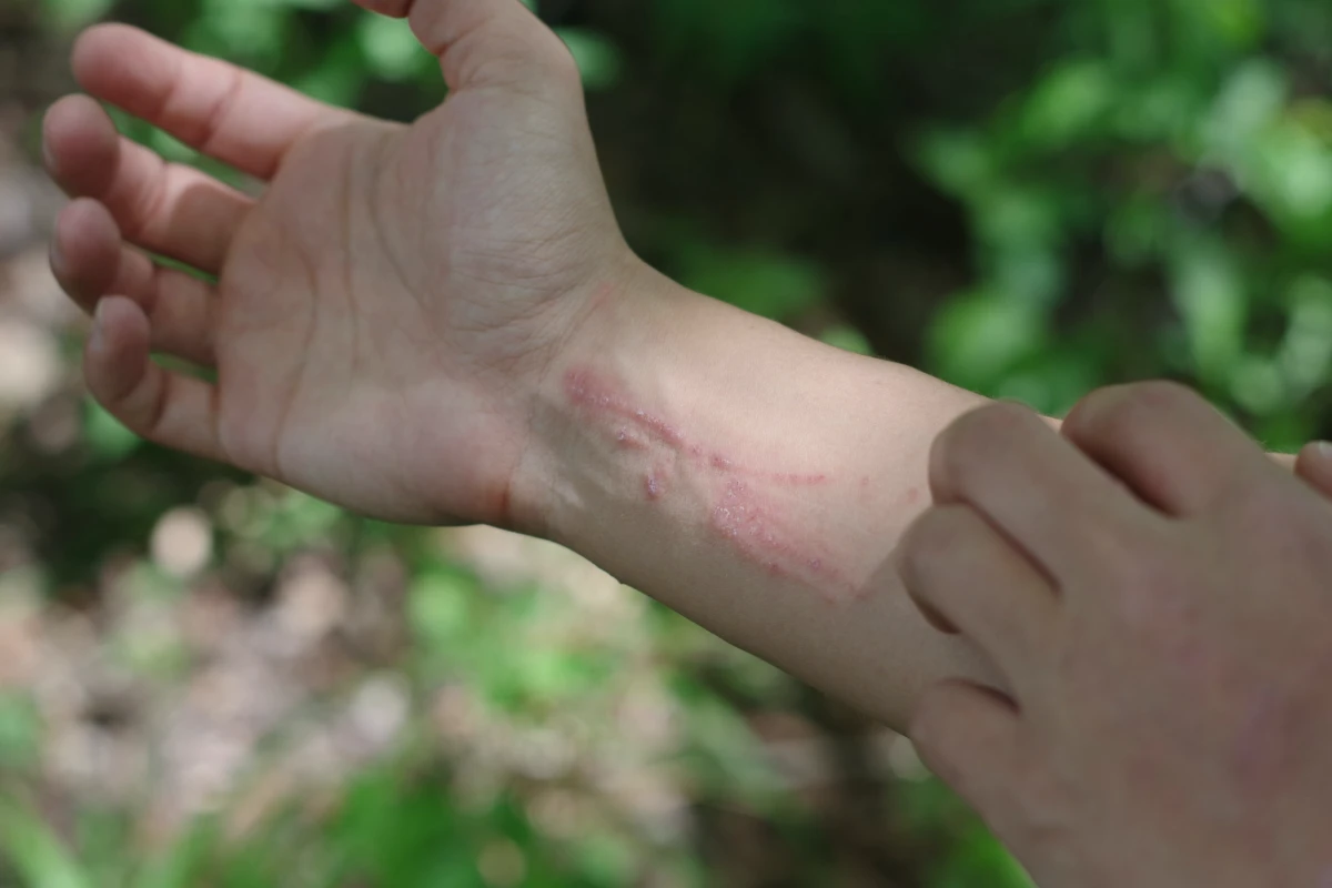red bumps on skin poison ivy rash