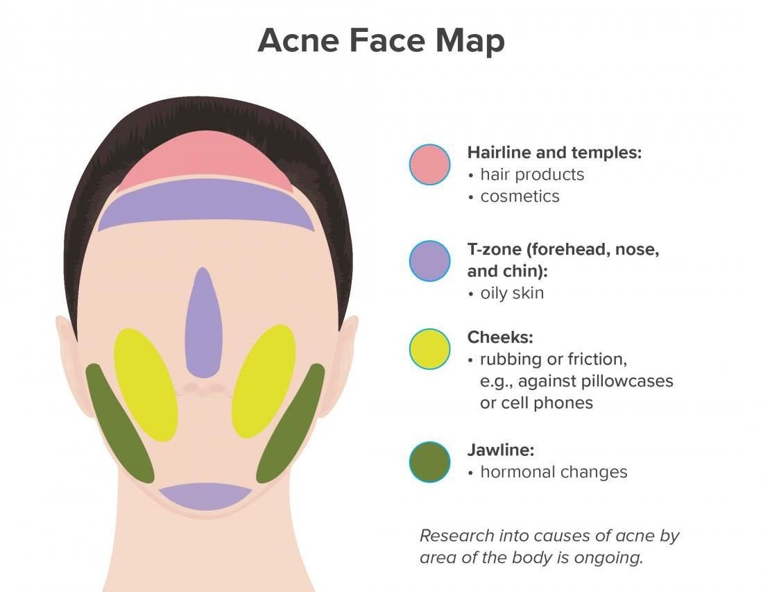 what does face acne say about your health