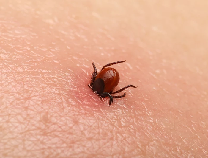 how to kill a tick tick burrowed in skin