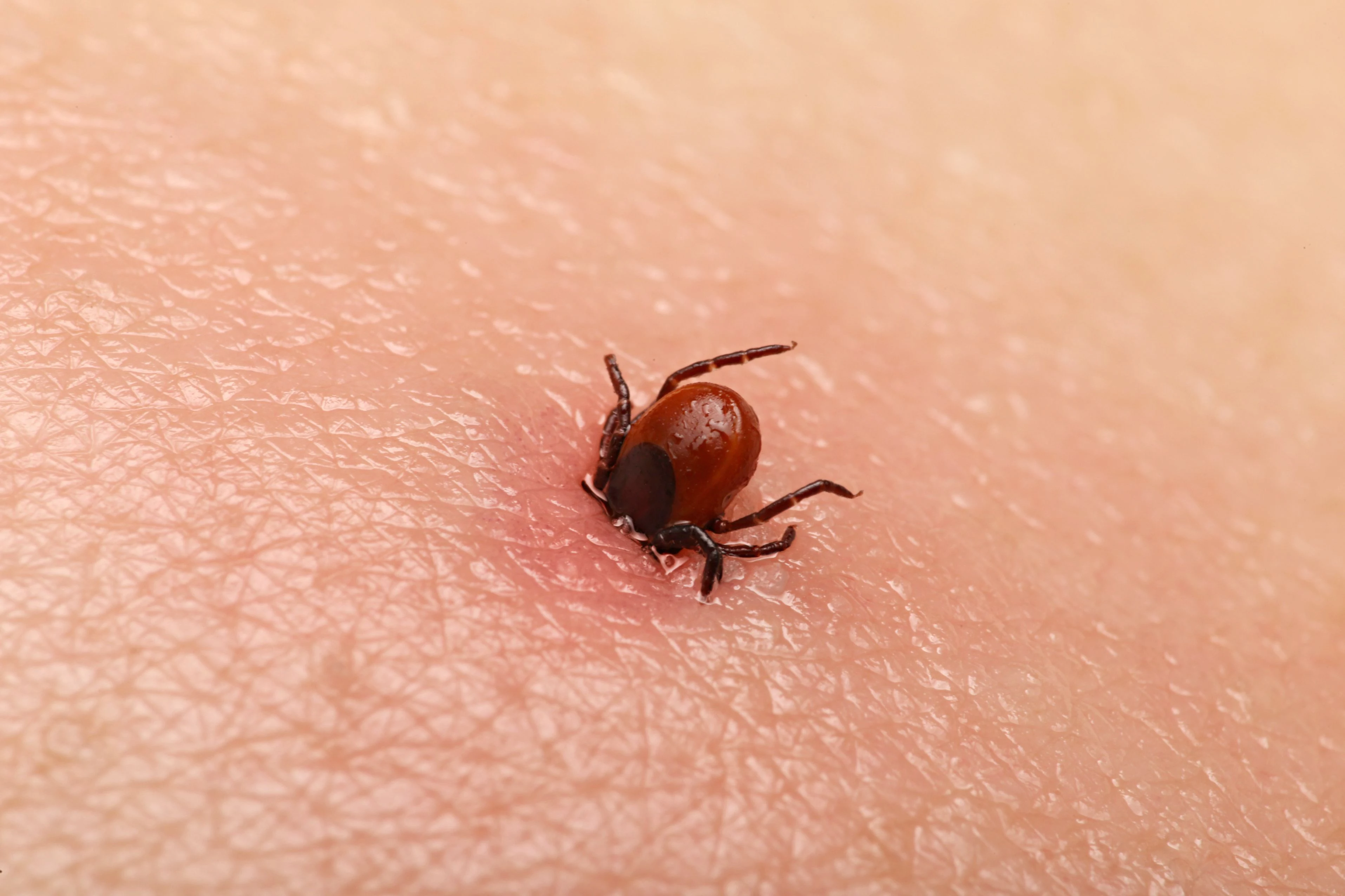 how to kill a tick tick burrowed in skin