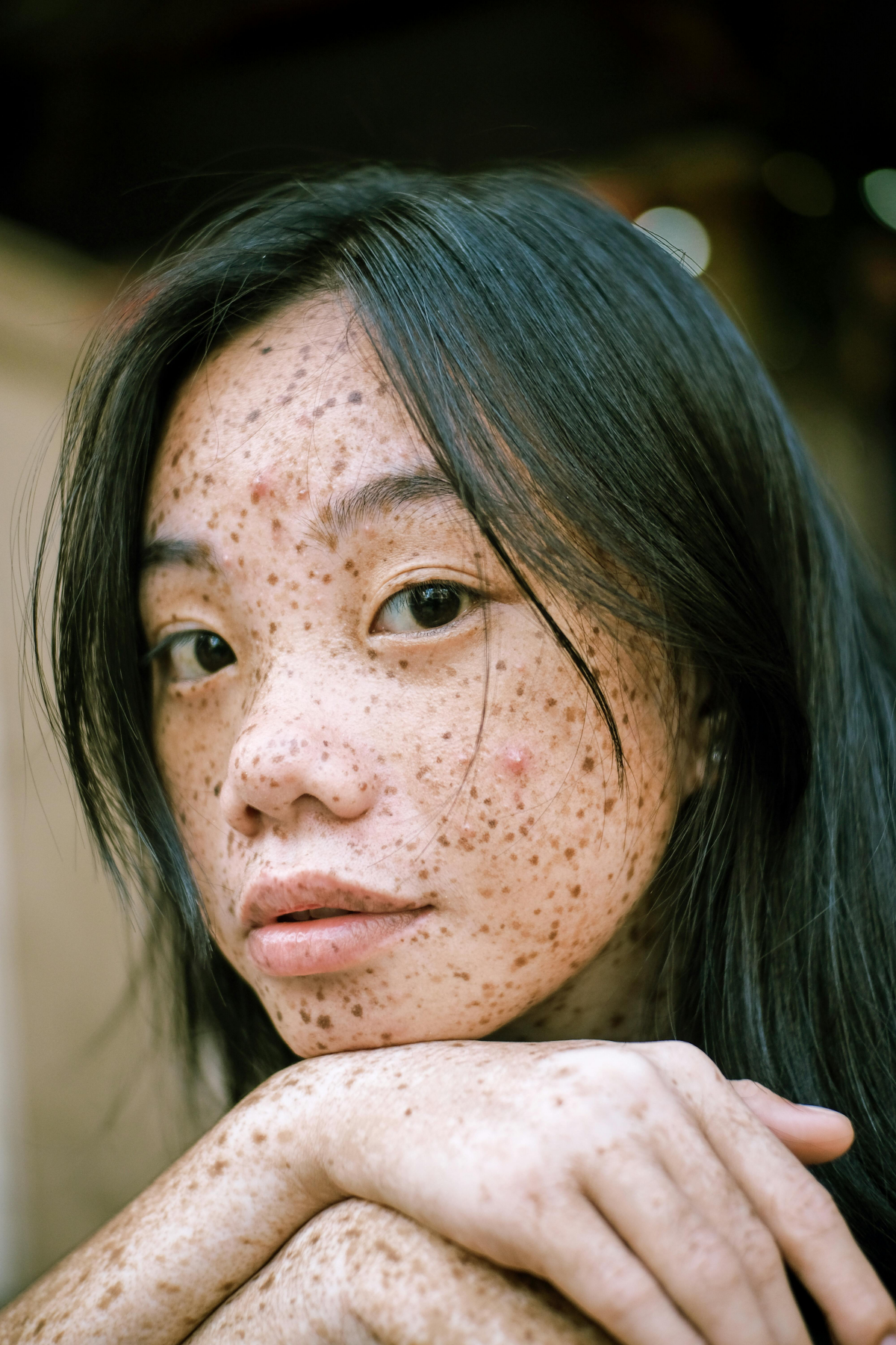 asian woman with a lot of freckles