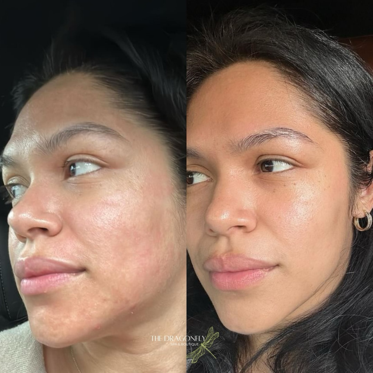 before and after results of microneedling