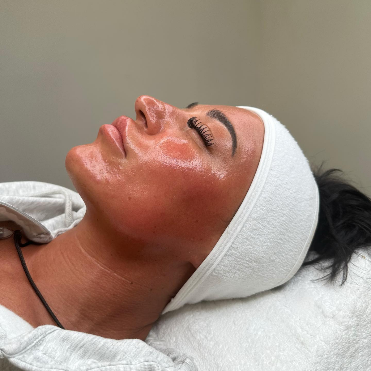 face with microneedling treatment