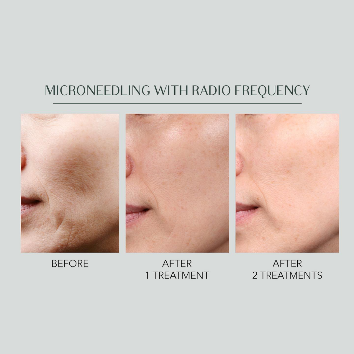 microneedling before and afterafter weeks