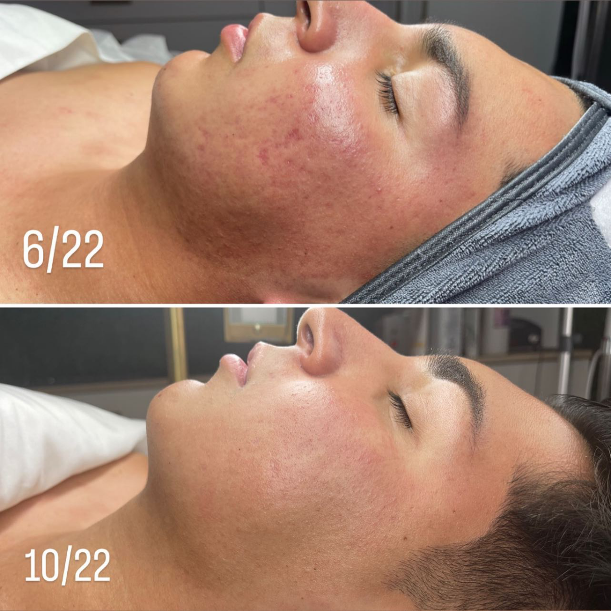 microneedling sessions before and after