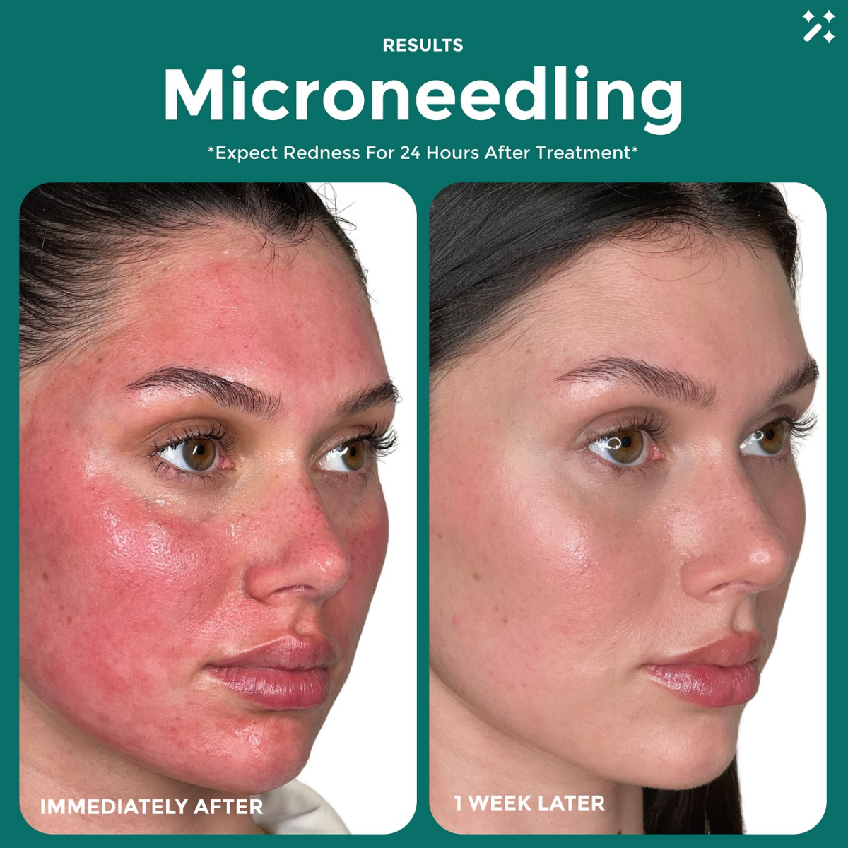 results of microneedling treatment before and after