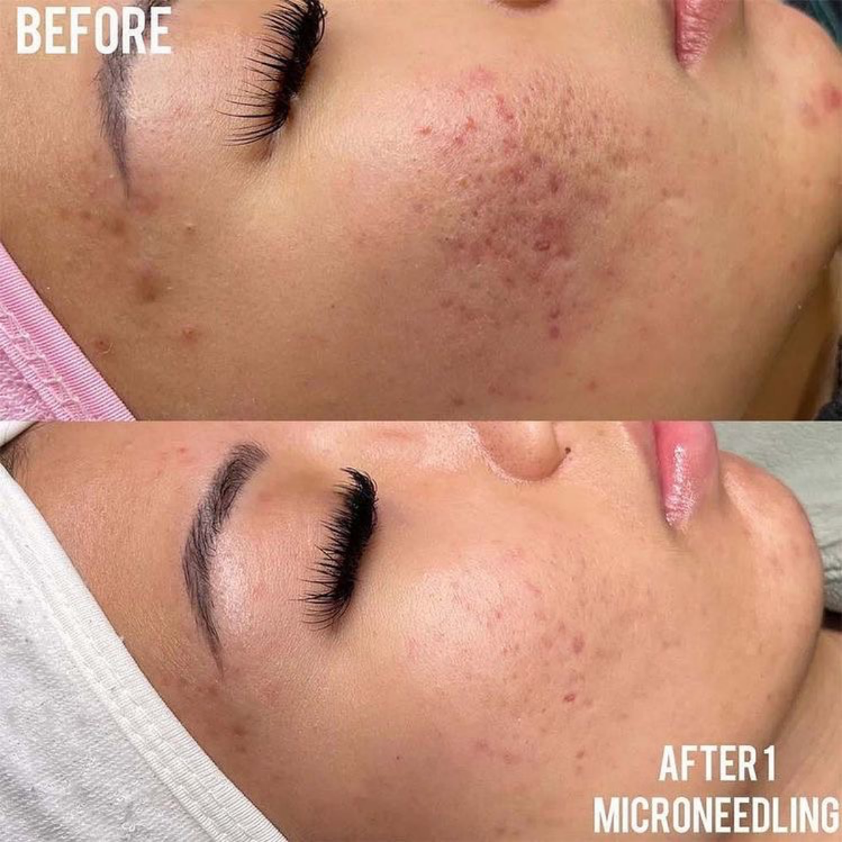 results of microneedling treatment